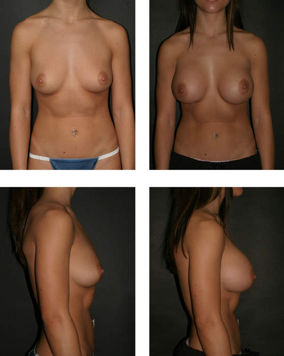 Breast augmentation: Surgical procedure