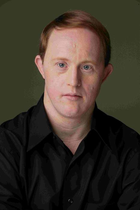 Chris Burke (actor): American Down syndrome advocate