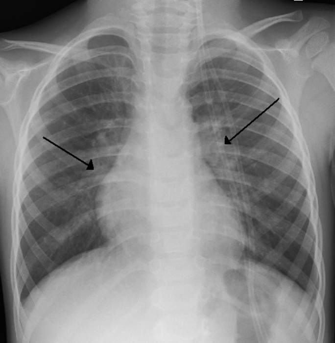 Respiratory syncytial virus: Species of a virus