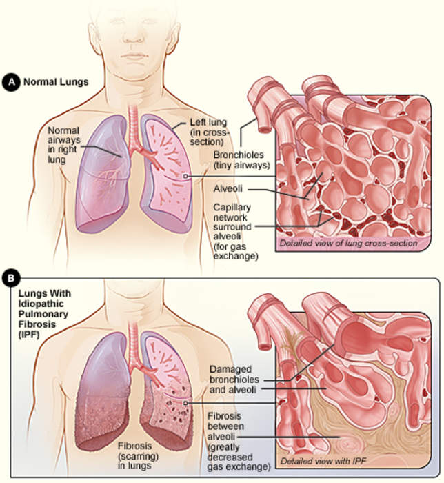 Idiopathic pulmonary fibrosis: Fibrosis of Lungs due to unknown causes